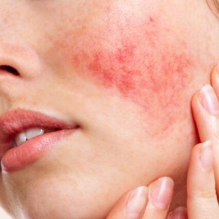 Rosacea